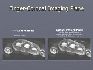 Finger-Coronal Imaging Plane
Relevant Anatomy Coronal Imaging Plane
*Prescribe plane parallel to anterior
metacarpal head. Scan through entire
finger. Include 2 adjacent fingers.
*
Thumb
Extensor Tendon
 
