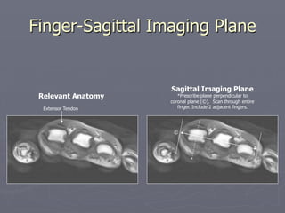 Finger-Sagittal Imaging Plane
Relevant Anatomy
Sagittal Imaging Plane
*Prescribe plane perpendicular to
coronal plane (©). Scan through entire
finger. Include 2 adjacent fingers.
*
©
Thumb
Extensor Tendon
 