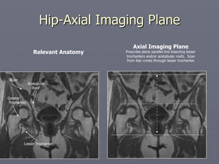 Hip-Axial Imaging Plane
Lesser Trochanter
Greater
Trochanter
Ilium
Acetabular
Roof
Relevant Anatomy
Axial Imaging Plane
Prescribe plane parallel line bisecting lesser
trochanters and/or acetabular roofs. Scan
from iliac crests through lesser trochanter.
 