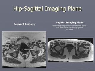 Hip-Sagittal Imaging Plane
Greater Trochanter
Femoral
Neck
Superior Pubic Ramus
Femoral Head
Ischium
Relevant Anatomy
Sagittal Imaging Plane
*Prescribe plane perpendicular to coronal plane.
Scan from acetabulum through greater
trochanter.
*
 