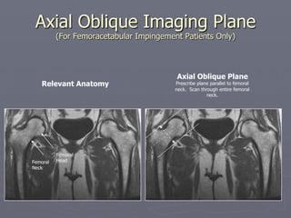 Axial Oblique Imaging Plane
(For Femoracetabular Impingement Patients Only)
Axial Oblique Plane
Prescribe plane parallel to femoral
neck. Scan through entire femoral
neck.
Relevant Anatomy
Femoral
Neck
Femoral
Head
 