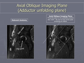 Axial Oblique Imaging Plane
(Adductor unfolding plane)
Relevant Anatomy
Axial Oblique Imaging Plane
*Prescribe plane to line paralleling anterior
Iliac crest*. Be sure to scan across pubic
symphysis at midline
*
*
Hip joint
 