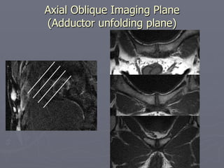 Axial Oblique Imaging Plane
(Adductor unfolding plane)
 