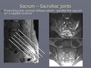 Sacrum – Sacroiliac joints
► Prescribing the coronal oblique plane: parallel the sacrum
on a sagittal localizer
 