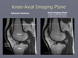 Knee-Axial Imaging Plane
P
A
T
Tibia
Femur
Patellar
Tendon
Insertion
Relevant Anatomy Axial Imaging Plane
Image from distal quad tendon
through patellar tendon insertion
Distal Quadriceps tendon
 