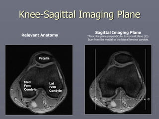 Knee-Sagittal Imaging Plane
Med
Fem
Condyle
Lat
Fem
Condyle
Patella
Relevant Anatomy
Sagittal Imaging Plane
*Prescribe plane perpendicular to coronal plane (©).
Scan from the medial to the lateral femoral condyle.
©
©
*
*
 