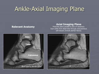 Ankle-Axial Imaging Plane
Tibia
Talus
Calcaneus
Relevant Anatomy
Axial Imaging Plane
Prescribe plane parallel to axis of calcaneus.
Scan ankle from distal tibia through subcutaneous
soft tissues (include plantar fascia).
Black band is plantar fascia
 