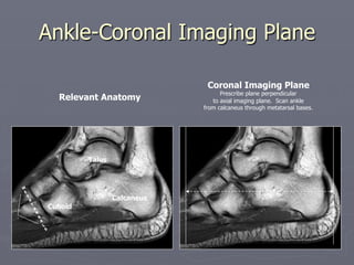 Ankle-Coronal Imaging Plane
Coronal Imaging Plane
Prescribe plane perpendicular
to axial imaging plane. Scan ankle
from calcaneus through metatarsal bases.
Calcaneus
Talus
Cuboid
Relevant Anatomy
 
