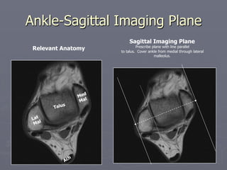 Ankle-Sagittal Imaging Plane
Talus
Sagittal Imaging Plane
Prescribe plane with line parallel
to talus. Cover ankle from medial through lateral
malleolus.
Relevant Anatomy
 
