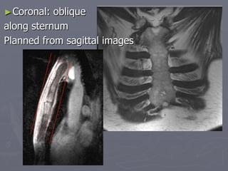 ►Coronal: oblique
along sternum
Planned from sagittal images
 