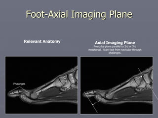 Foot-Axial Imaging Plane
Relevant Anatomy Axial Imaging Plane
Prescribe plane parallel to 2rd or 3rd
metatarsal. Scan foot from navicular through
phalanges.
N
A
V
Phalanges
 