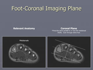 Foot-Coronal Imaging Plane
Relevant Anatomy
Metatarsals
1
2
3
4
5
Coronal Plane
*Prescribe plane parallel to 1st and 5th metatarsal
Shafts. Scan through entire foot.
*
 