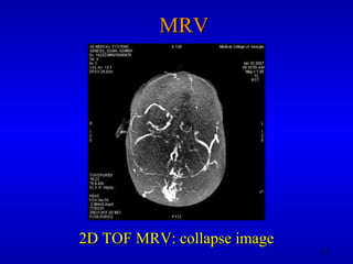 MRV 2D TOF MRV: collapse image 