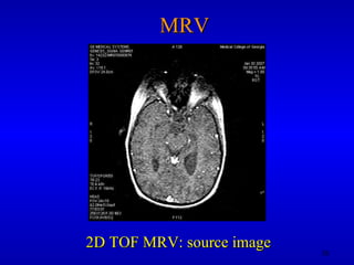 MRV 2D TOF MRV: source image 