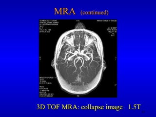 MRA  (continued) 3D TOF MRA: collapse image  1.5T 