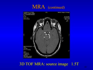 MRA  (continued) 3D TOF MRA: source image  1.5T 
