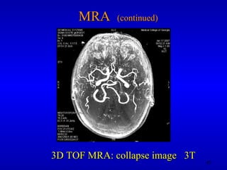 MRA  (continued) 3D TOF MRA: collapse image  3T 