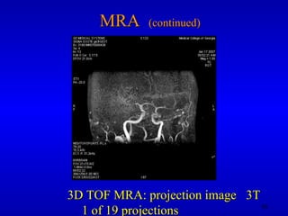 MRA  (continued) 3D TOF MRA: projection image  3T 1 of 19 projections 