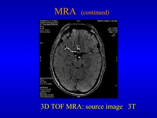 MRA  (continued) 3D TOF MRA: source image  3T 