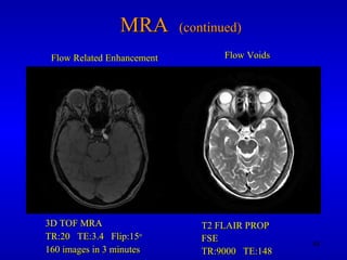 MRA  (continued) 3D TOF MRA TR:20  TE:3.4  Flip:15 o 160 images in 3 minutes T2 FLAIR PROP FSE TR:9000  TE:148 Flow Related Enhancement Flow Voids 