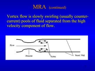 MRA  (continued) Vortex flow is slowly swirling (usually counter-current) pools of fluid separated from the high velocity component of flow. 