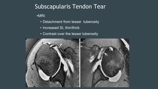 mri in orthopaedics its importance and understanding | PPTX