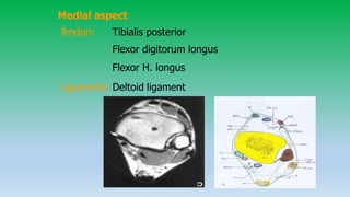 Medial aspect
Tendon: Tibialis posterior
Flexor digitorum longus
Flexor H. longus
Ligaments: Deltoid ligament
 