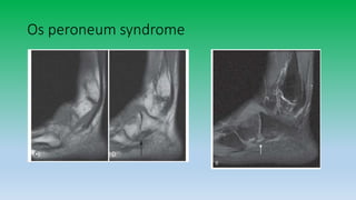 Os peroneum syndrome
 