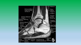Mri anatomy of ankle radiology ppt pk