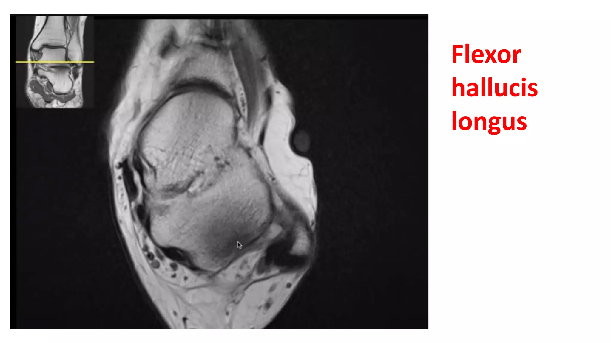 Flexor
hallucis
longus