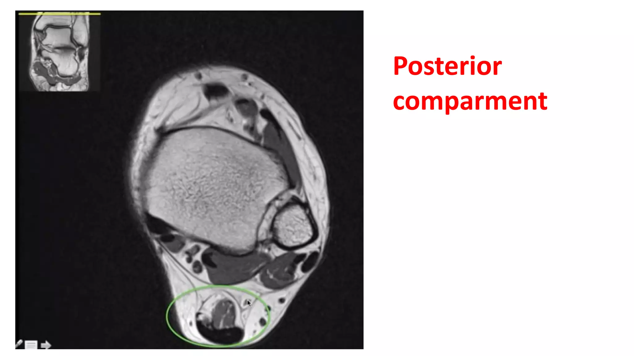 Posterior
comparment