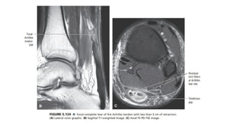 MRI ANKLE AND COMMON PATHOLOGIES (1).pptx