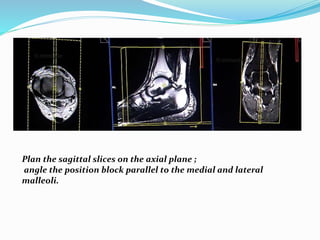 Plan the sagittal slices on the axial plane ;
angle the position block parallel to the medial and lateral
malleoli.
 