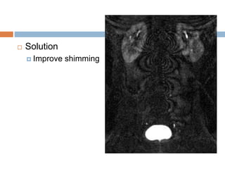  Solution
 Improve shimming
 