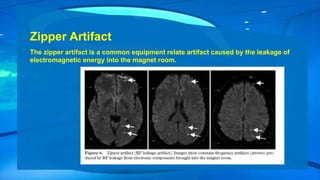 Zipper Artifact
The zipper artifact is a common equipment relate artifact caused by the leakage of
electromagnetic energy into the magnet room.
 