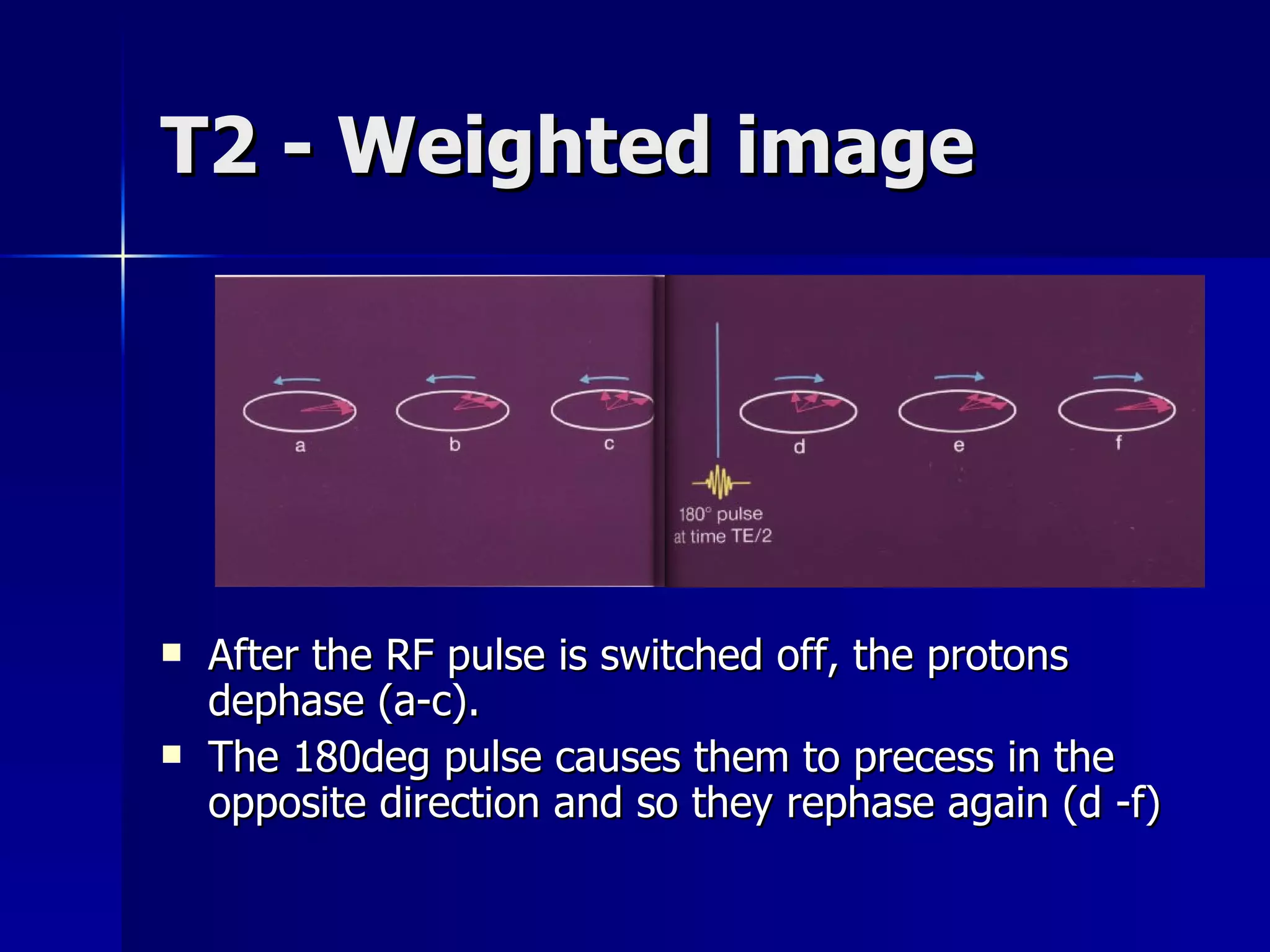 T2 - Weighted image After the RF pulse is switched off, the protons dephase (a-c).  The 180deg pulse causes them to precess in the opposite direction and so they rephase again (d -f) 
