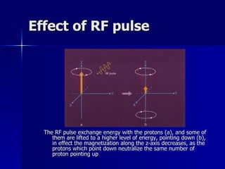 Effect of RF pulse The RF pulse exchange energy with the protons (a), and some of them are lifted to a higher level of energy, pointing down (b), in effect the magnetization along the z-axis decreases, as the protons which point down neutralize the same number of proton pointing up 