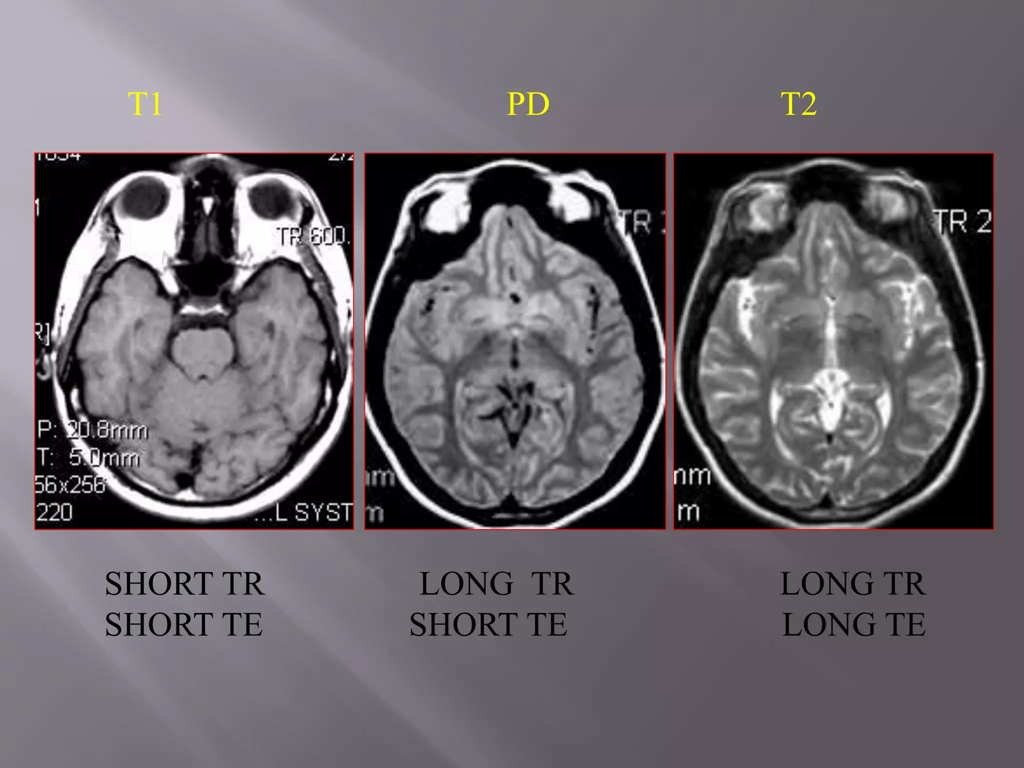 T1 PD T2
SHORT TR LONG TR LONG TR
SHORT TE SHORT TE LONG TE
 