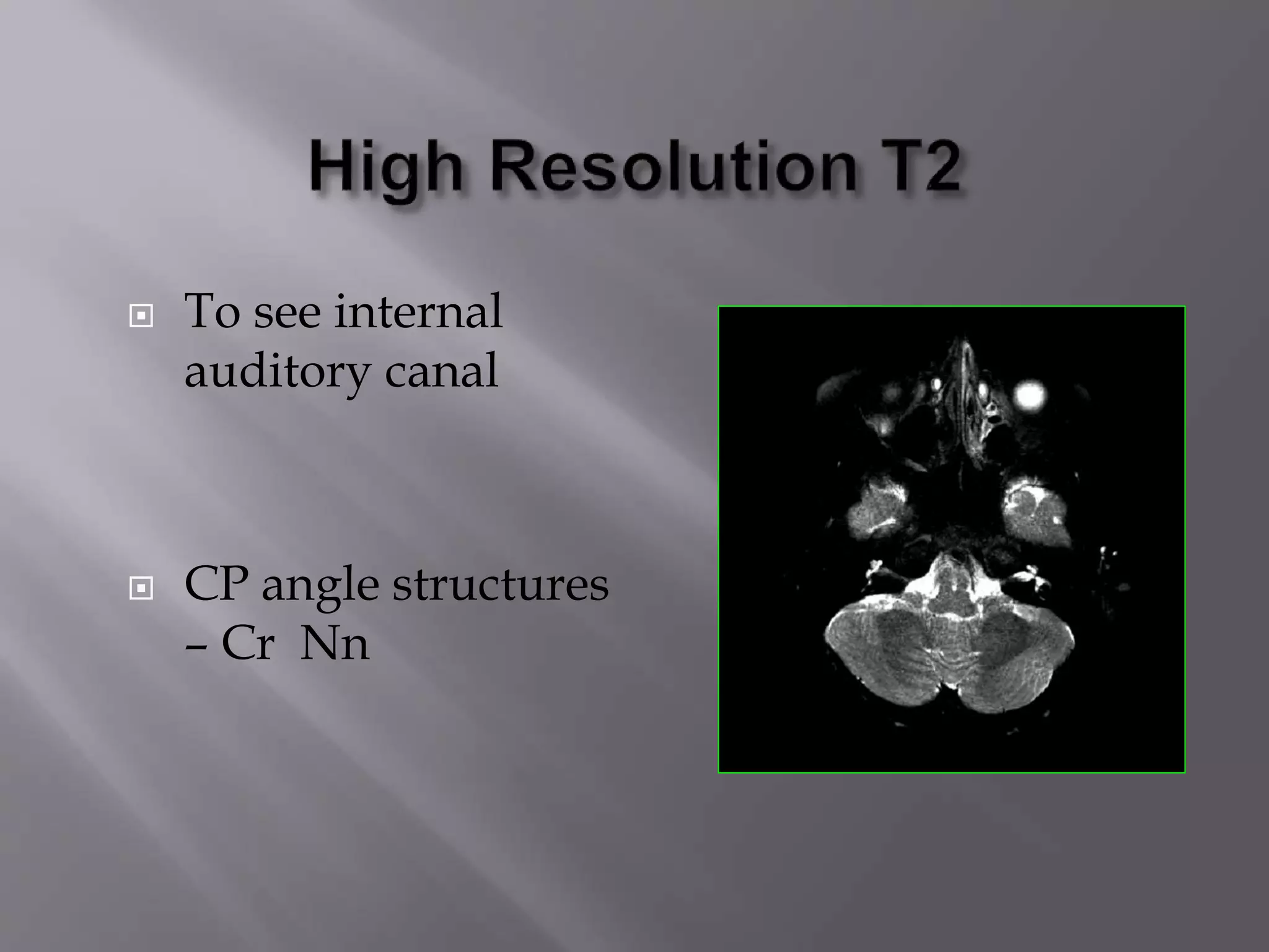  To see internal
auditory canal
 CP angle structures
– Cr Nn
 