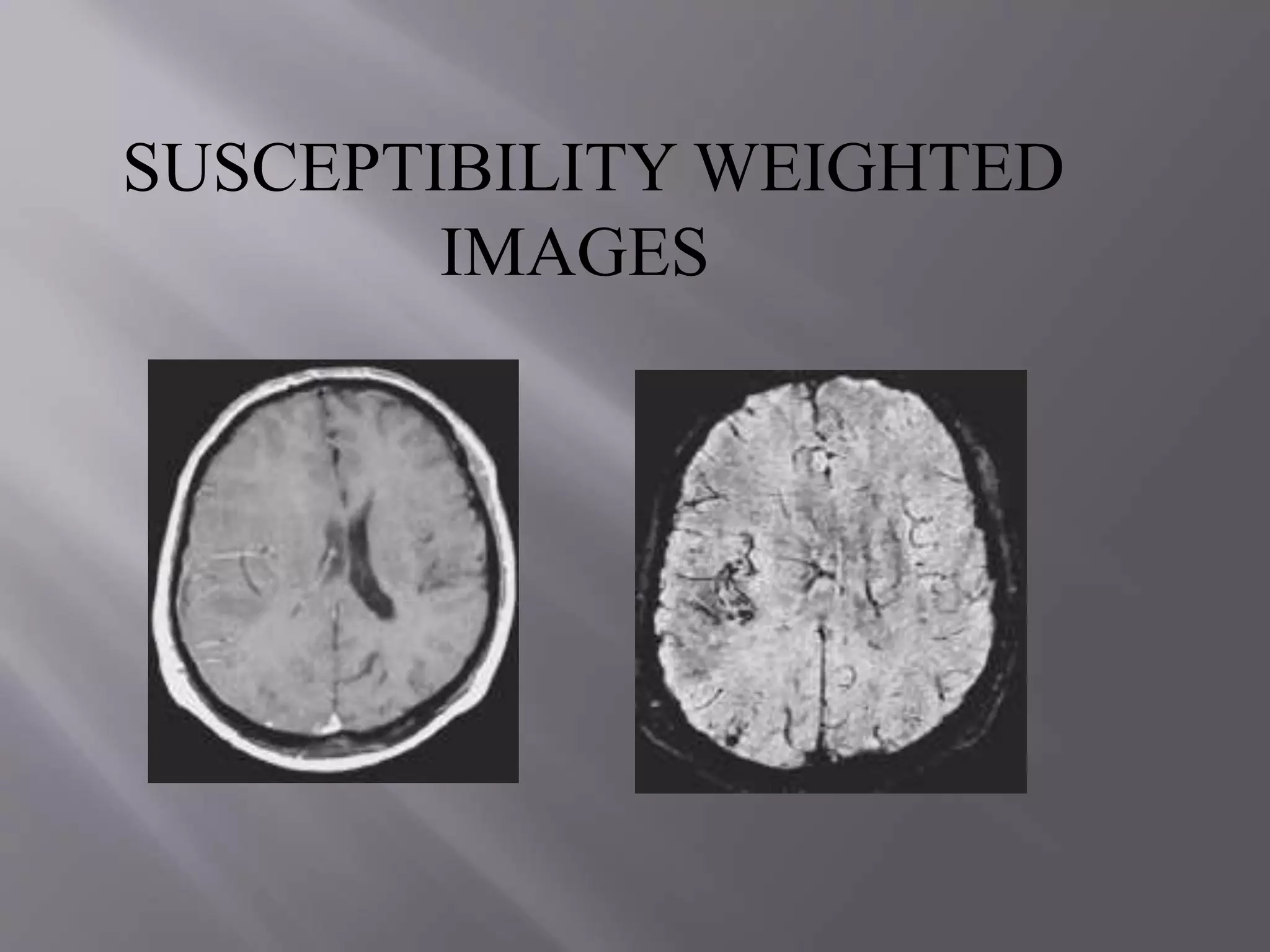 SUSCEPTIBILITY WEIGHTED
IMAGES
 