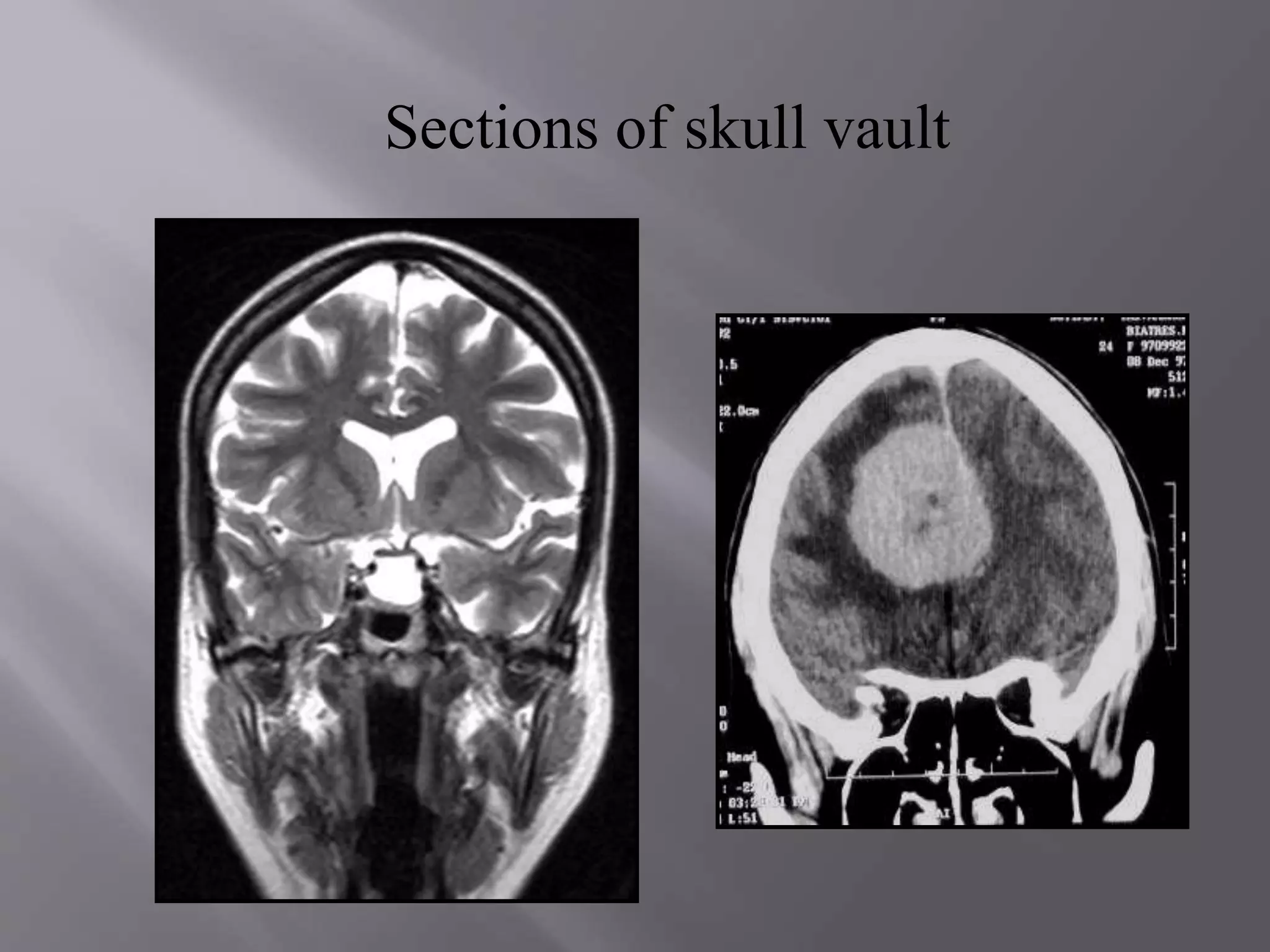 Sections of skull vault
 