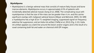 Myelolipoma
• Myelolipoma is a benign adrenal mass that consists of mature fatty tissues and bone
marrow elements. Myelolipoma occurs in approximately 6.5% of patients with
incidentally detected adrenal masses (Song et al, 2008). The complicating issue with
myelolipomas is that the size of the mass can be greater than 4 cm, and this carries
significant overlap with malignant adrenal lesions (Meyer and Behrend, 2005). On MRI
a myelolipoma has a high SI on T1-weighted imaging, suppressed signal on frequency
selective fat suppression, and an India ink artifact (Taffel et al, 2012) (Fig. 2-21). India
ink artifact appears as a dark line around the lesion and/or organs and is the result of a
voxel containing both fat and water on chemical shift OP images.
 