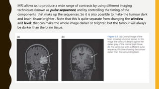 MRI allows us to produce a wide range of contrasts by using different imaging
techniques (known as pulse sequences) and by controlling the timing of the
components that make up the sequences. So it is also possible to make the tumour dark
and brain tissue brighter . Note that this is quite separate from changing the window
and level: that can make the whole image darker or brighter, but the tumour will always
be darker than the brain tissue.
 