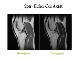 Spin Echo Contrast
PD weighted T2 weighted
 