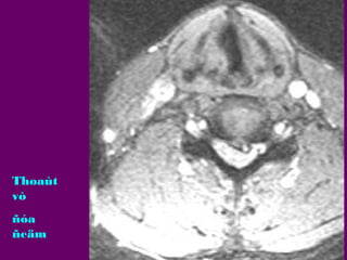 Thoaùt
vò
ñóa
ñeäm

 