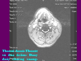 Thoaùi hoaù-Thoaùt
vò ñóa ñeäm- Daøy
daây chaèng vaøng-

 