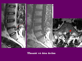 Thoaùt vò ñóa ñeäm

 