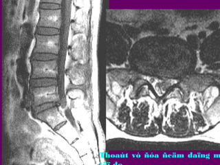 Thoaùt vò ñóa ñeäm daïng m

 