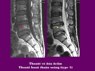Thoaùt vò ñóa ñeäm
Thoaùi hoaù thaân soáng (type 1)

 