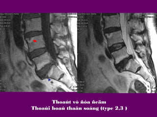 Thoaùt vò ñóa ñeäm
Thoaùi hoaù thaân soáng (type 2,3 )

 